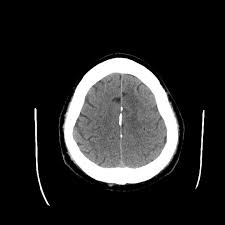 The anterior cerebral artery supplies the frontal lobes and areas that control the legs, and contralateral hemiparesis of the legs occurs accordingly. Anterior Cerebral Artery Infarction Radiology Case Radiopaedia Org