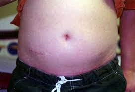 Crohn S Disease Causes Symptoms Diet