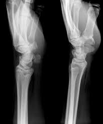 Image result for Pisiform Bone