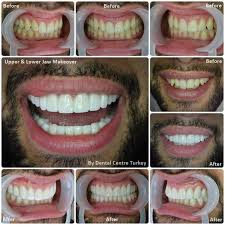 Smile Makeover With 20 E Max Crowns