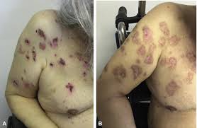 Image result for Pemphigoid