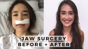 Another method of underbite correction is a reverse pull face mask or headgear. Underbite Correction Without Surgery Epic New Guide