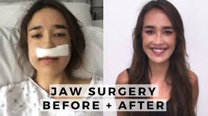 By far too many people are being told they need both jaw surgery and braces. Underbite Correction Without Surgery Epic New Guide