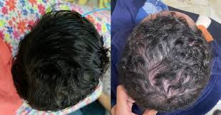 Ortho - Satisfying results after 4 months of cranial remodeling orthosis  treatment. نتيجه جميله لطفل جديد عمره ٨ شهور باستخدام خوذه ستارباند من  امريكا كل التحيه المبدعه المتفوقة دكتوره ساره علي @sarahmali1 @