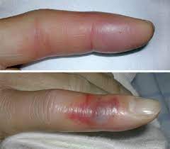 Infektion Der Fingerbeere Springerlink