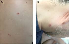 If this happens, you can have pain, light sensitivity, discharge, and a gritty feeling in the eye. Unusual Manifestation Of Disseminated Herpes Simplex Virus Type 2 Infection Associated With Pharyngotonsilitis Esophagitis And Hemophagocytic Lymphohisitocytosis Without Genital Involvement Bmc Infectious Diseases Full Text
