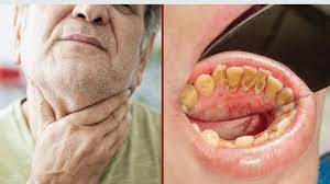 Oral cancers are highly prevalent, associated with a high death rate and much rarely found on the cheek. Oncologist Reveals The Causes And Early Signs Of Oral Cancer