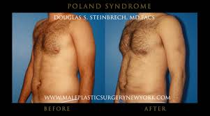 Patients with poland syndrome might go under plastic surgery in dallas to correct the chest wall deformity, improve the pectoral or breast contour, and recover confidence. Poland Syndrome Surgery Before And After Images Poland Syndrome Gallerymale Plastic Surgery