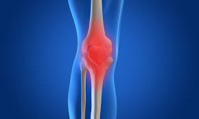 Knee pain may be the result of an injury, such as a ruptured ligament or torn cartilage. Total Knee Replacement The Good The Bad And The Ugly
