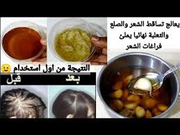 وصفة الثوم والقرنفل لعلاج تساقط الشعر ضعيها علي فراغات الشعر ينبت من جديد تعالج الصلع الثعلبة نهائيا Youtube