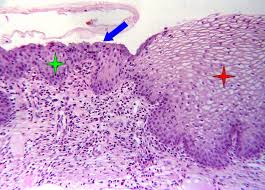 In premenopausal women, the transformation zone is fully located on the ectocervix. Histopathology Of The Uterine Cervix Digital Atlas