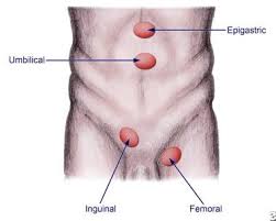 Image result for Inguinal hernia man
