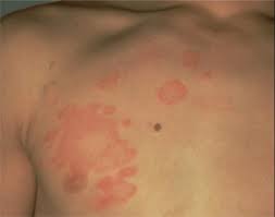 Most often, an otc treatment works well to clear up ringworm. Ringworm Dermatologist In Sandy Springs Ga Roswell Ga Alpharetta Ga Cumming Ga