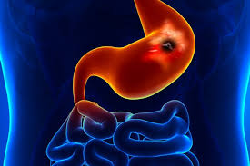 Foods You Should Avoid If You Have Stomach Ulcerguardian Life The Guardian Nigeria News Nigeria And World News Cartoon stomach character unhealthy sick perforated ulcer emoji emotion. foods you should avoid if you have