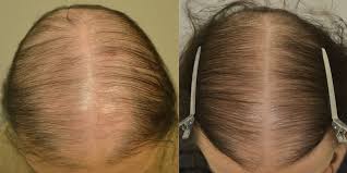 If you're experiencing female pattern hair loss and you'd like to do something about it, spironolactone could be a promising option for you. Spironolactone For Females Only Before After Photos Hair Restoration Of The South New Orleans La
