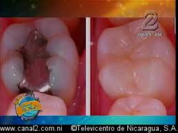 Calzas Dentales Youtube
