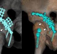 Outcomes of spring-locking plate fixation method using ...