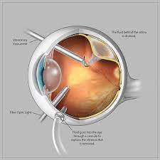 Check spelling or type a new query. Retinal Detachment Medical Opticsmedical Optics