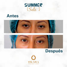 Okara Medicina Y Laser No Mas Ojeras Este Verano Increibles Resultados De Nuestro Tratamiento De Relleno De Ojeras Para Que Este Verano Te Olvides De Las Ojeras Hundidas Y Oscuras
