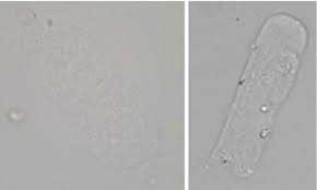 Image result for Urinary Cast