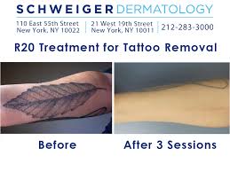 New york magazine recognized the laser & skin surgery center as offering the best tattoo removal in nyc, thanks to our specialized expertise, technology, and training. Remove Tattoo Permanently Februari 2018