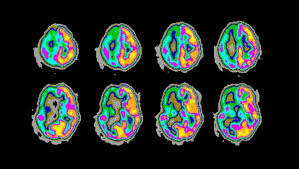 Epilepsy is a group of neurological disorders characterized by recurrent epileptic seizures. What Causes Epilepsy In Children