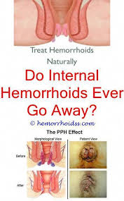 Pin On How To Get Rid Of Hemorrhoids