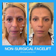 Full Face Rejuvenation