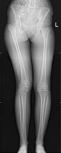 Image result for Functional Leg Length Discrepancy