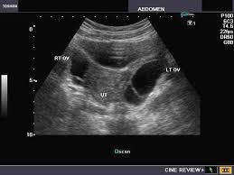 Note the bladder is not fluid filled nor readily visible. A Gallery Of High Resolution Ultrasound Color Doppler 3d Images Ovaries
