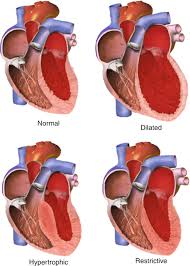 Image result for Cardiomyopathy