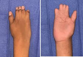 For unknown reasons, this disorder occurs more than twice as often in males than in females. Poland Syndrome Causes Symptoms Diagnosis Treatment Prognosis