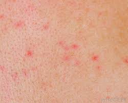 Image result for genital herpes