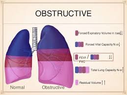 Obstructive Vs Restrictive Lung Disease Respiratory