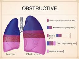 obstructive vs restrictive lung disease respiratory