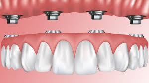 The cost of this sedation will vary depending on what type. Implant Supported Dentures