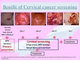 Maybe you would like to learn more about one of these? Cervical Cancer Screening Updates Dr Arun Shahi Md