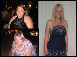 403 Forbidden Sleeve Surgery Gastric Sleeve Gastric Sleeve Surgery