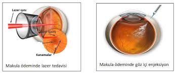 Diyabetik Retinopati Prof Dr Gokhan Gulkilik
