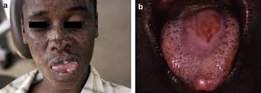 Xeroderma pigmentosum (xp) is an autosomal recessive genetic disorder characterized by cutaneous and ocular photosensitivity and an increased risk of developing cutaneous neoplasms. Xeroderma Pigmentosum A Review And Case Series Sciencedirect