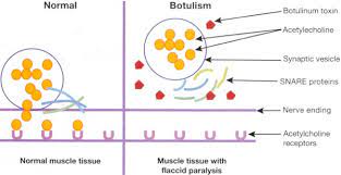 Botulism is a rare but serious illness caused by a toxin that attacks the body's nerves. Botulinum Toxin Botox Specialist 2021 Top Laser Dermatologist Nyc