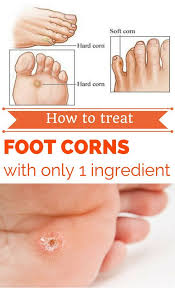 How To Treat Foot Corns With Only 1 Ingredient Get Rid Of Corns Corn Treatment Corn On Toe