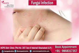 Fungal Skin Infections Can Cause A Variety Of Different Skin Rashes Some Are Red Scaly And Itchy Others May Dry Skin Body Fungus Skin Fungal Infection Skin
