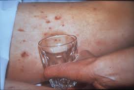 Purpura fulminans is an acute illness commonly associated with meningococcemia or invasive streptococcal disease, and it is typically characterized by disseminated intravascular coagulation (dic) and purpuric skin lesions. What Is The Meningitis Rash Meningitis Research Foundation