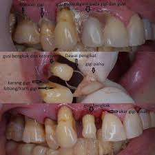 Untuk harga pasang implant per gigi di klinik kami dikenakan biaya 10 juta rupiah pak.itu sudah termasuk crown giginya pak. Kenapa Gigi Palsu Akrilik Klinik Pergigian Sabariah Facebook
