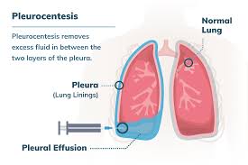 This type is called pleural mesothelioma. Mesothelioma Pleurocentesis Benefits Risks More