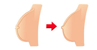 Image result for Nipple Inversion