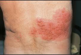 Primary infection usually results in varicella (chickenpox), after which vzv becomes latent in ganglionic neurons along the entire neuraxis. Pictures Of Viral Skin Diseases And Problems Varicella Zoster Viral Infection On Chest Wall