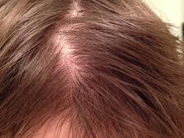 For starters, hair follicles are responsible for regulating hair growth rates. Is This Normal Black Dots Pics Baldtruthtalk Com