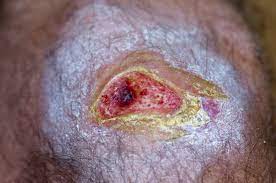 Wound Infections: How To Identify And Treat